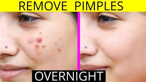 How To Remove Pimples Fast Naturally and Permanently – Vel illum