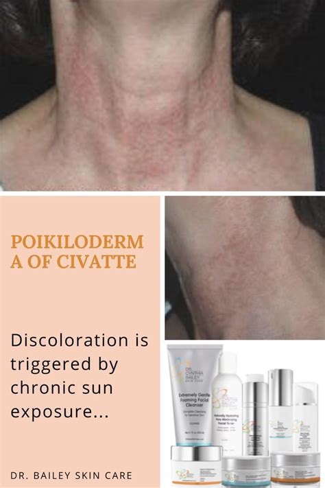 What is Poikiloderma of Civatte? | Skin therapy, Antioxidants skin ...