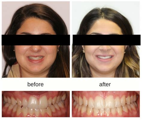 Teen Invisalign and Braces - Before and After | Hometown Orthodontics