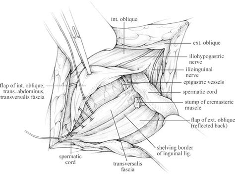 Figure 5 from The Shouldice repair for groin hernias. | Semantic Scholar