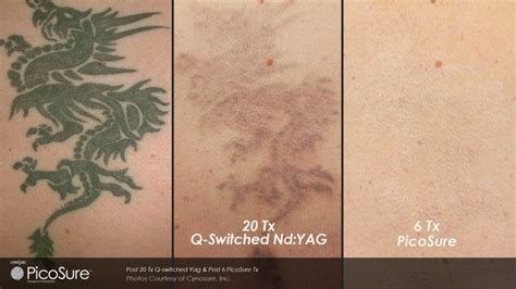 Tattoo removal cost - How much does it cost to remove a tattoo? - 207 Laser & Integrative MED