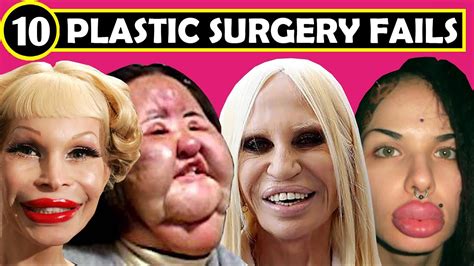 Top 10 Botched Plastic Surgery Fails Plastic Surgery - vrogue.co