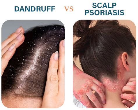 Scalp Psoriasis vs. Dandruff | Medium