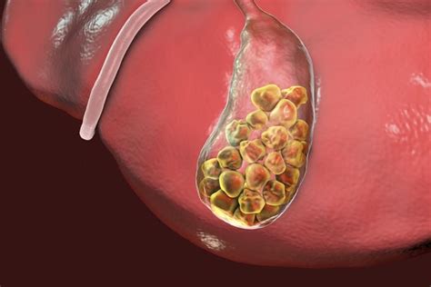 Understanding Gallbladder Sludge and Its Impact on Health - Facty Health