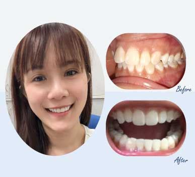 Dr Clear Aligners | Redefining Smiles with Invisible Braces