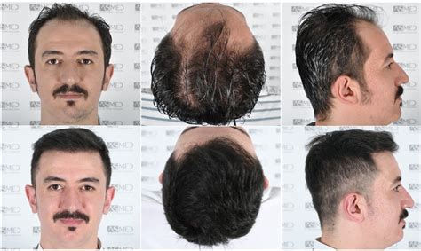 Norwood 4 Hair Transplantation Results | Asmed Hair Transplant