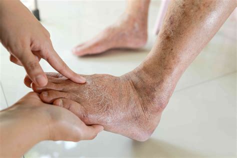 Diabetes Foot Care: Tips and Importance