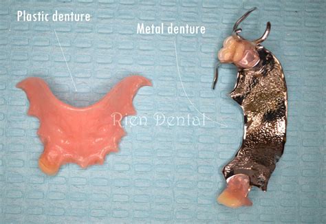 Metal vs plastic partial dentures.