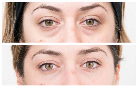 Everything you need to know about non-surgical eye bag removal