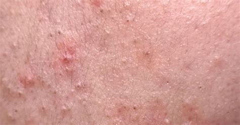 Nodular Acne: Causes, Treatment, Home Remedies & More