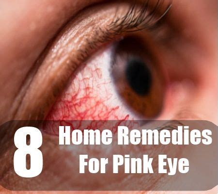 8 Best Home Remedies For Pink Eye Pink Eye Home Remedies, Natural Pink Eye Remedy, Natural Cures ...