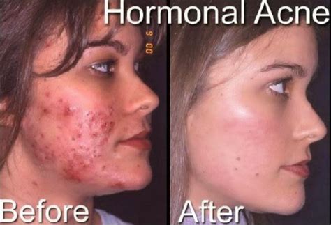 Hormonal Acne Before and After - Acne Picture