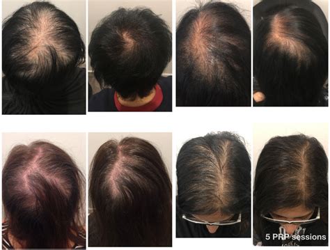 PRP Hair Loss Treatment | Sydney, Melbourne & Brisbane