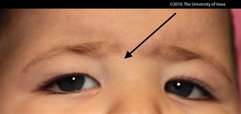 Dermoid Cyst. EyeRounds.org - Ophthalmology - The University of Iowa