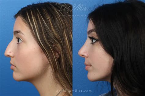 Rhinoplasty Swelling Stages: What to Expect - Philip Miller MD