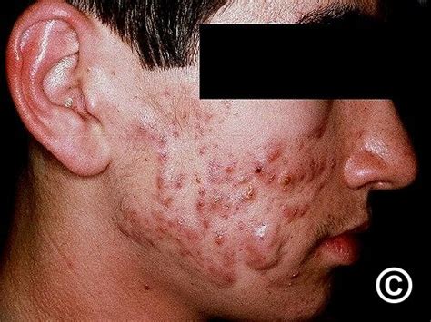 Acne vulgaris