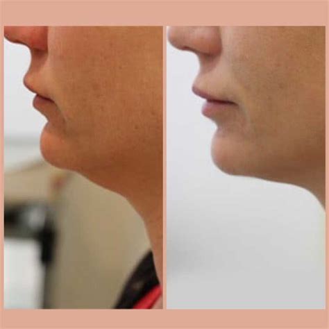 Lipodissolve Before And After Photos Of A Double Chin Fat Reduction Treatment - Harbour Medispa