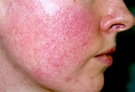 Acne Rosacea Causes and Diagnose – The Natural Cure