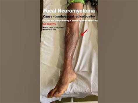 Focal neuromyotonia in lumbosacral radiculopathy #neurology #neetpg # ...