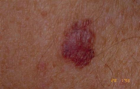 Tiny pinpoint red dots on skin pictures - emailholden