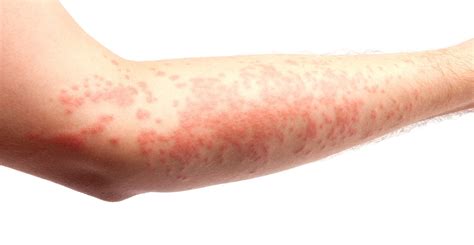 Erythema Marginatum Vs Erythema Multiforme