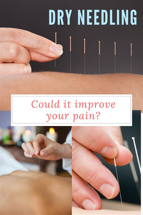 Dry Needling vs Acupuncture - PainPathways Magazine | Dry needling, Dry needling therapy ...