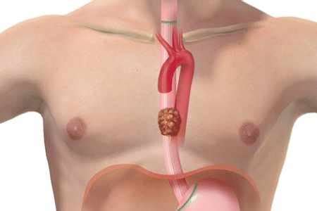 Esophagectomy in India: Causes, Procedure, Hospitals