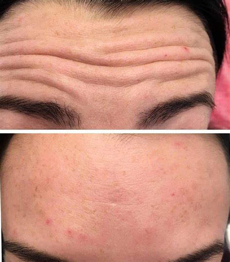 Botox Forehead Lines Before And After | Botox, Botox forehead, Facelift