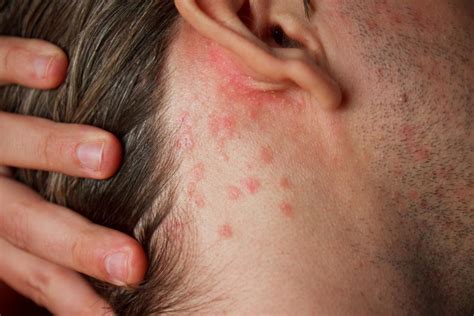 Skin Rash On Face And Behind Ears | Severe Side Effects
