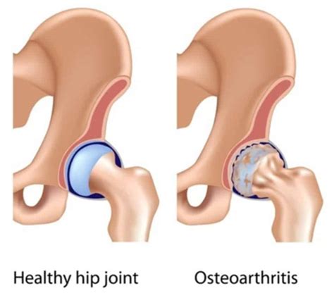 Hip Arthritis Treatment Chillicothe, OH - Hip Osteoarthritis Care