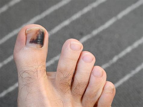 STUBBED TOES CAN RESULT IN NAIL BED INJURIES