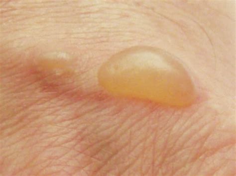 Heal Blisters Faster at Home - HubPages