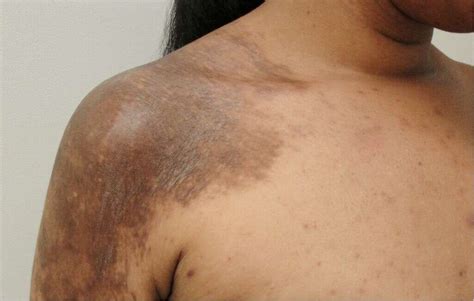 Morphea: What Is Morphea?