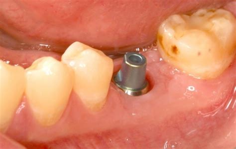 Dental Implant Crown - Dental News Network