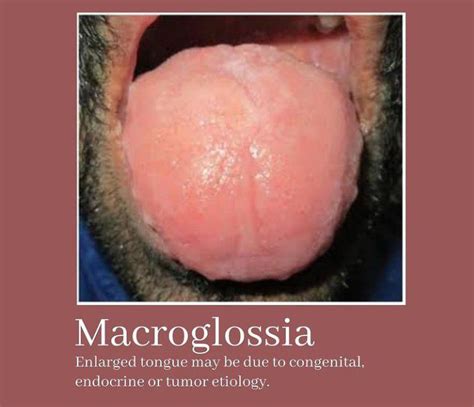 Macroglossia - MEDizzy