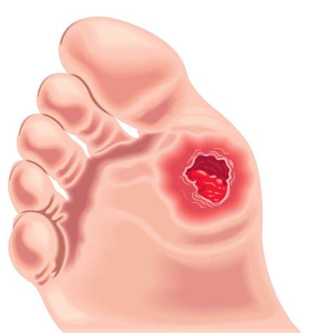 Foot Ulcers : Causes, Symptoms and Treatment Options