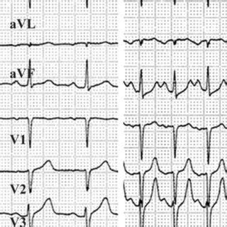 Prevalences and univariate comparisons of major ECG criteria for AVNRT... | Download Scientific ...