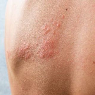 Shingles (Herpes Zoster) - Dermatologist in Munster, IN | SKIN Dermatology