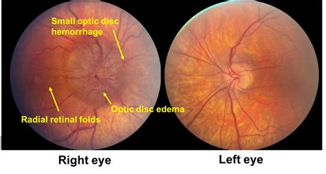 Optic nerve sheath meningioma – Case-Based Neuro-Ophthalmology - An Tâm