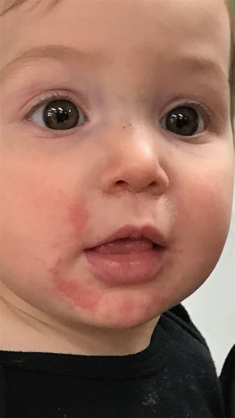 Red Rash On Child's Mouth | Allergy Trigger