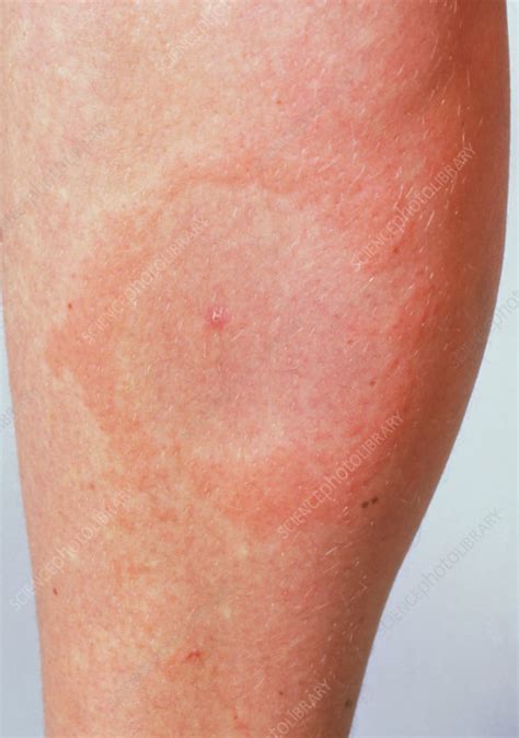 Lyme Disease Rash Looks Like