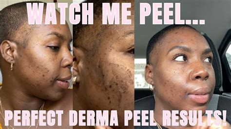 CHEMICAL PEEL RESULTS | THE PERFECT DERMA PEEL | BEFORE & AFTER RESULTS - YouTube