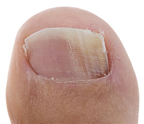 Psoriasis Under The Toenails: [Nail Pits, Causes & Best Treatment]