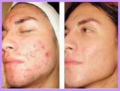 HOW TO TREAT DIFFERENT TYPES OF ACNE SCARS