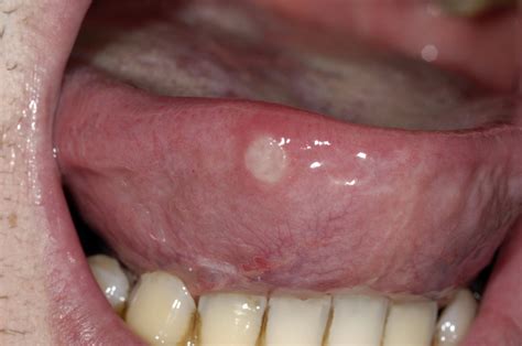 Mouth ulcers - NHS