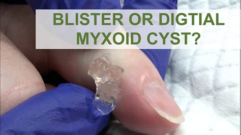 Blister or a Digital Myxoid Cyst? | Dr. Derm - YouTube