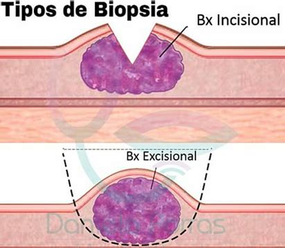 Biopsia Dibujo