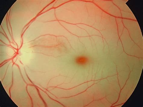 4 Signs You May Have Retinal Artery Occlusion -- Symptoms, Causes ...