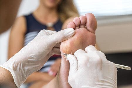 See Your Podiatrist for Callus Removal — Podiatry Group of Annapolis, P.A.