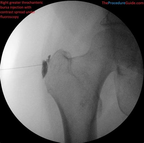 Fluoroscopic Guided Greater Trochanteric Bursa Injection – Technique and Overview - The ...